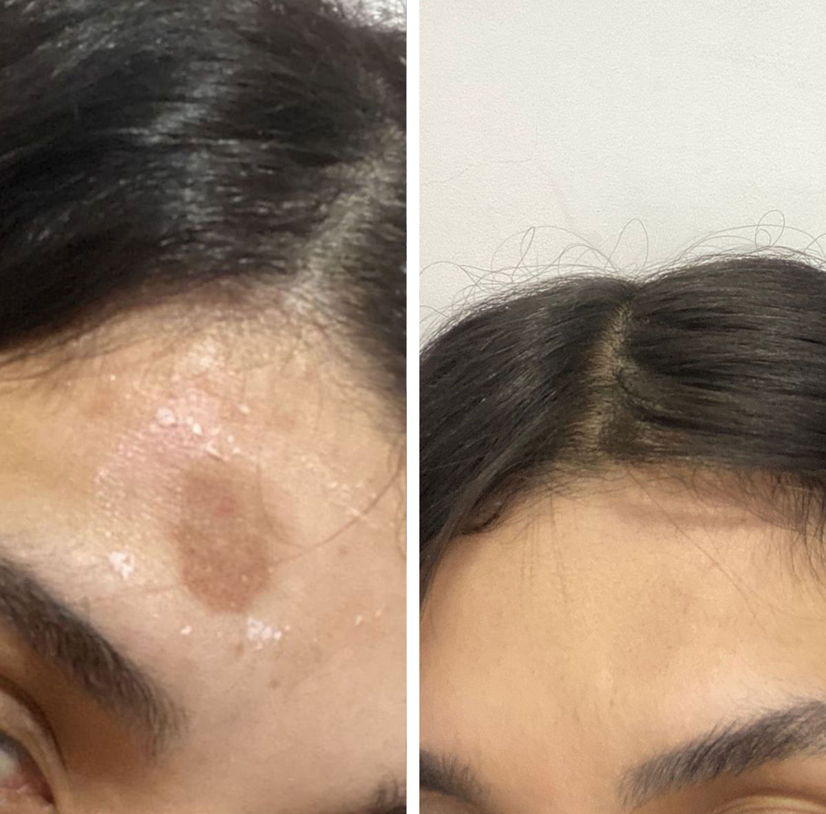 Before and after appearance of uneven skin tone