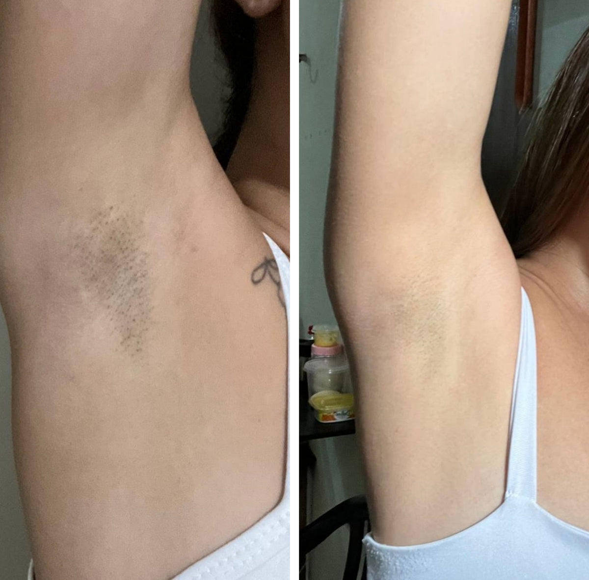 Before and after underarm skin appearance