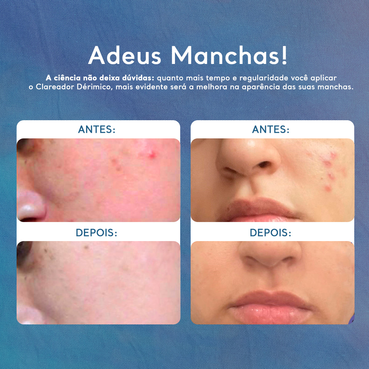 Creme Clareador de Manchas no Rosto e Corpo Clareador Dérmico 60g 4 Unidades